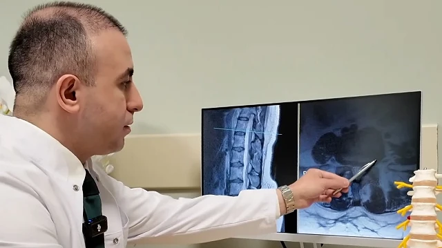 Bel Fıtığı Hakkında Bilinmesi Gerekenler: Ameliyat Son Çare